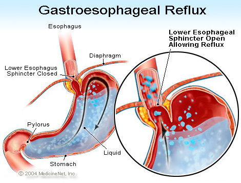 pierdere în greutate reflux esofagian