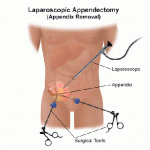 apendicita 3